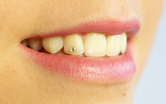 
                Aplicação de Piercing Dentário por 19€ em Alcântara!
            