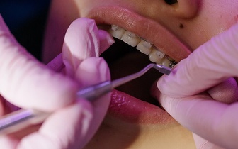 
                Aparelho Fixo Dentário Superior e Inferior + Destartarização Simples por 59€ em Massamá!
            