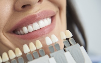 
                Branqueamento Dentário com Moldeiras + Destartarização por 69,90€ em Alcântara!
            