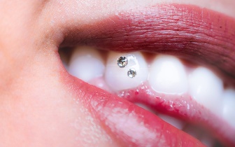 Aplicação de Piercing Dentário por 19€ no Marquês de Pombal!